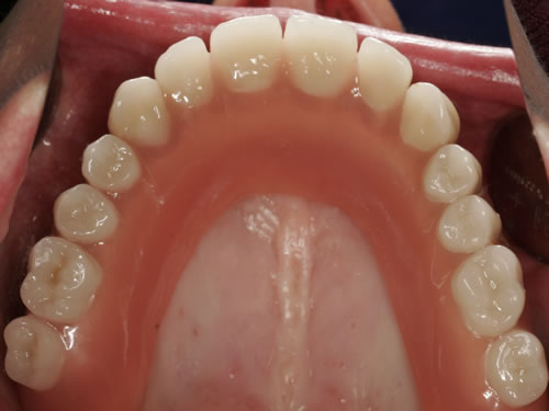 Ohne zahnersatz gaumenplatte oberkiefer Eine Zahnprothese